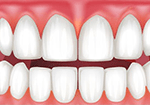 Receding gums