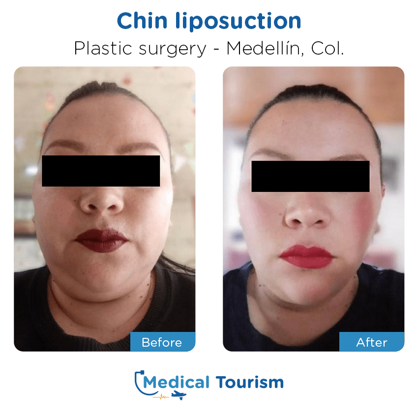 Patient before and after medical tourism