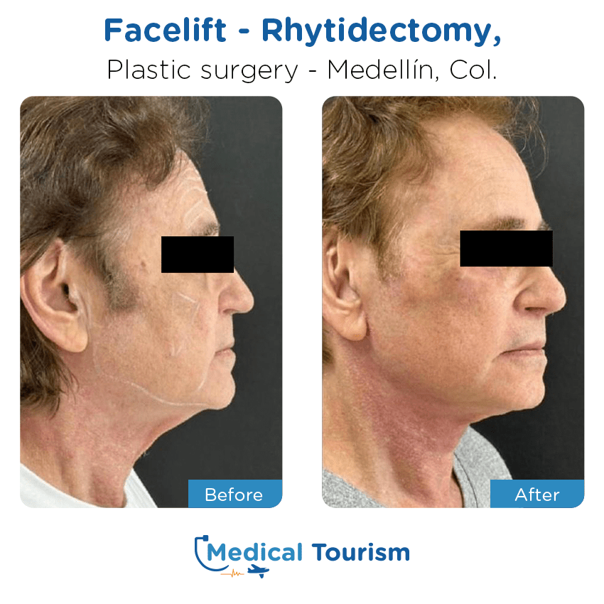 Patient before and after medical tourism