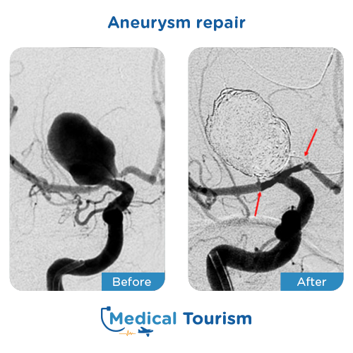 Aneurism before and after medical tourism international