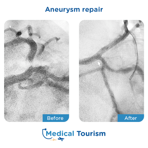 Aneurism before and after medical tourism international