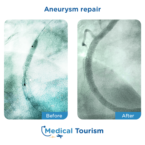 Aneurism before and after medical tourism international