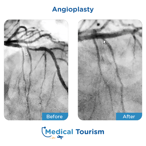 Aneurism before and after medical tourism international