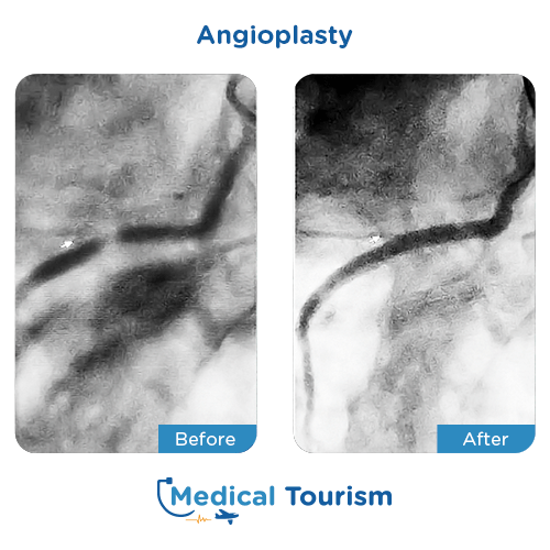 Aneurism before and after medical tourism international