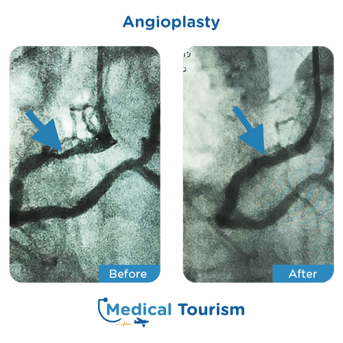 Aneurism before and after medical tourism international