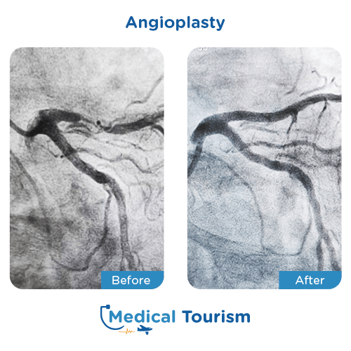 Aneurism before and after medical tourism international