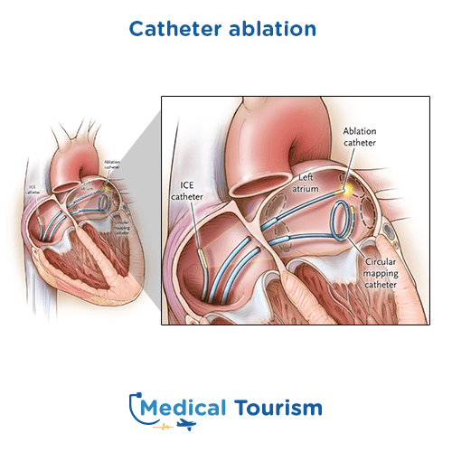 Aneurism before and after medical tourism international