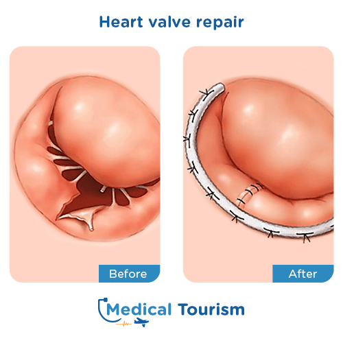 Aneurism before and after medical tourism international