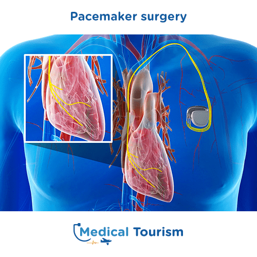 Pacemaker before and after medical tourism international