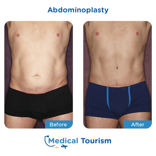 Abdominoplasty before and after medical tourism international