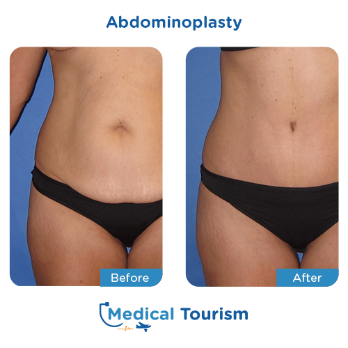 Abdominoplasty before and after medical tourism international