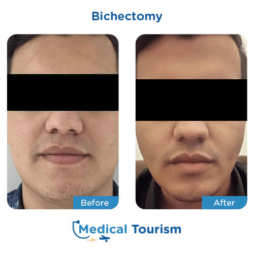 Bichectomy before and after medical tourism international