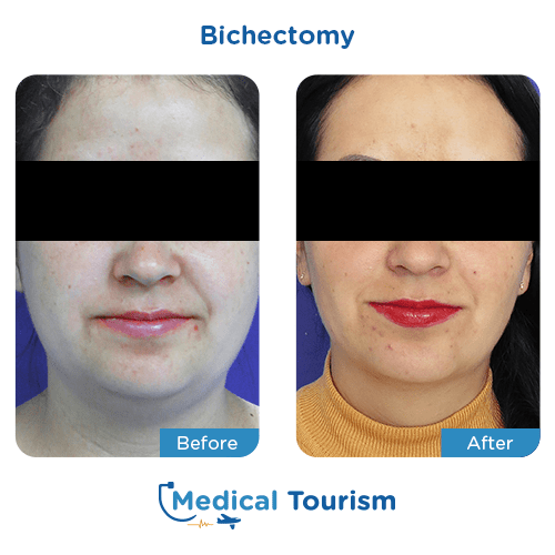 Bichectomy before and after medical tourism international
