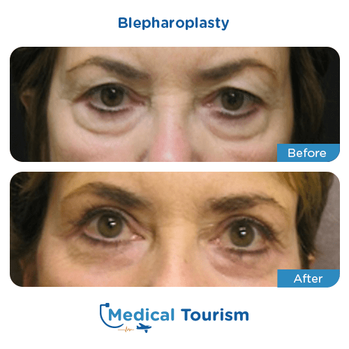 Blepharoplasty before and after medical tourism international