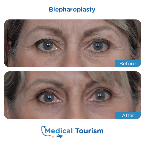 Blepharoplasty before and after medical tourism international