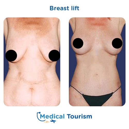 Breast lift before and after medical tourism international