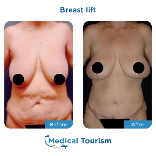 Breast lift before and after medical tourism international