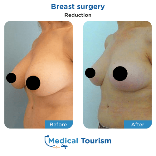 Breast surgery before and after medical tourism international