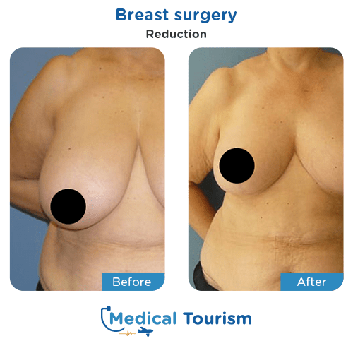 Breast surgery before and after medical tourism international