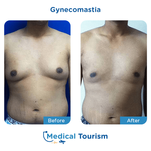 Gynecomastia before and after medical tourism international