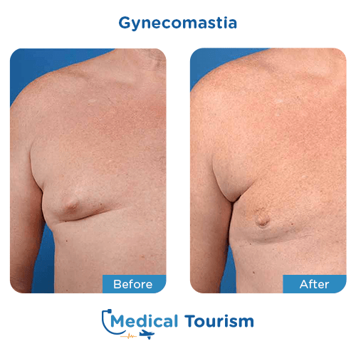 Gynecomastia before and after medical tourism international