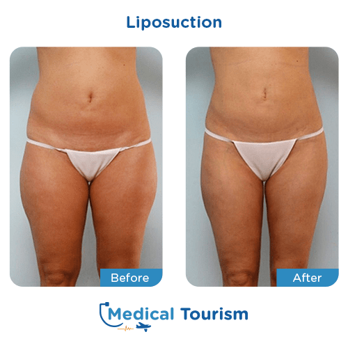 Liposuction before and after medical tourism international