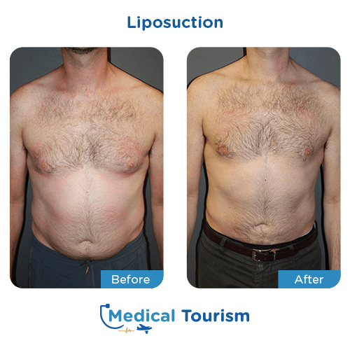 Liposuction before and after medical tourism international