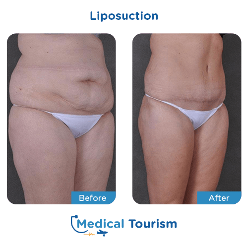 Liposuction before and after medical tourism international