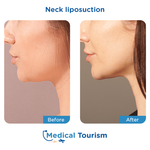 Neck liposuction before and after medical tourism international
