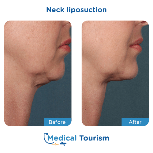 Neck liposuction before and after medical tourism international