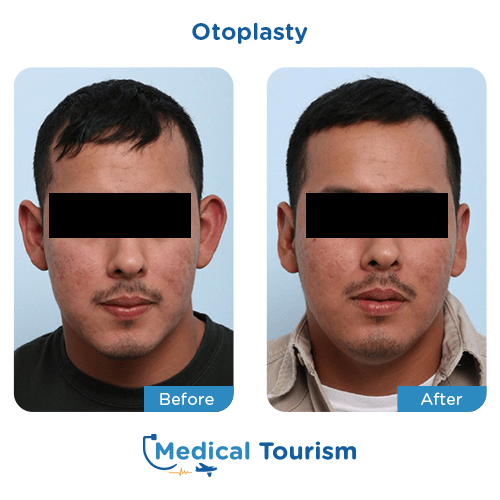 Otoplasty before and after medical tourism international