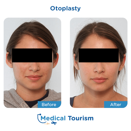 Otoplasty before and after medical tourism international