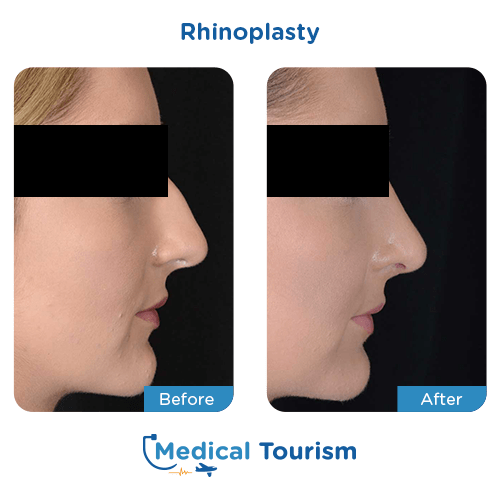 Rhinoplasty before and after medical tourism international