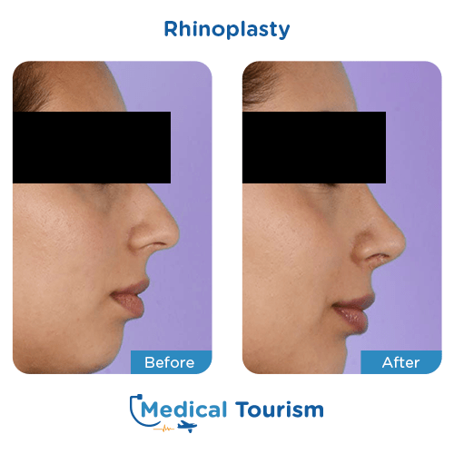 Rhinoplasty before and after medical tourism international