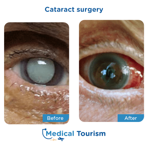 Aneurism before and after medical tourism international