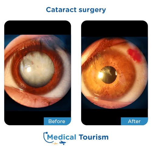 Aneurism before and after medical tourism international