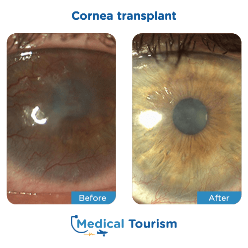 Aneurism before and after medical tourism international