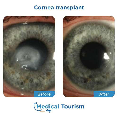 Aneurism before and after medical tourism international