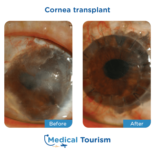 Aneurism before and after medical tourism international