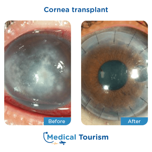 Aneurism before and after medical tourism international