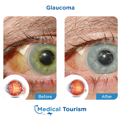 Aneurism before and after medical tourism international