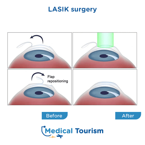 Aneurism before and after medical tourism international