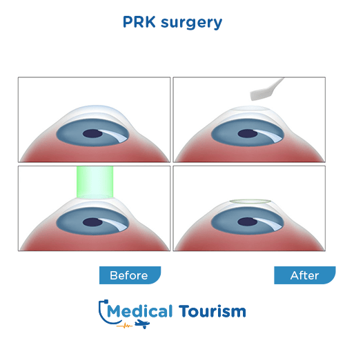 Aneurism before and after medical tourism international