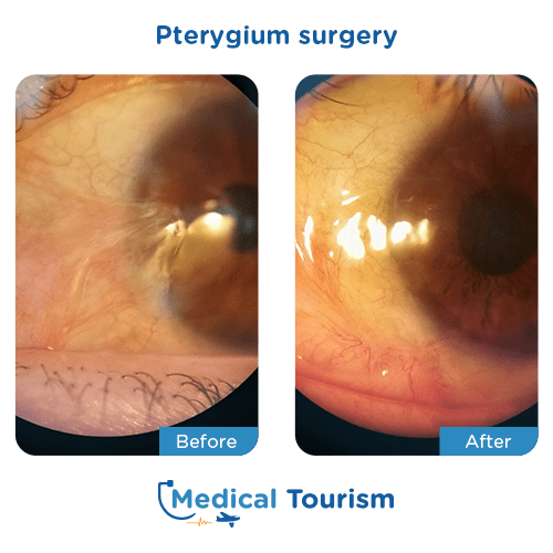 Aneurism before and after medical tourism international