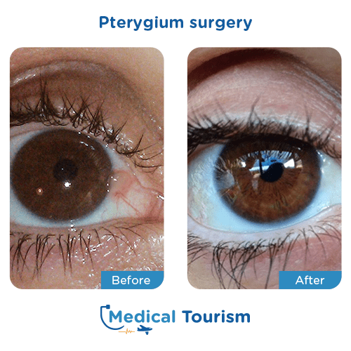 Aneurism before and after medical tourism international