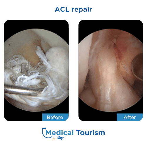 ACL repair before after