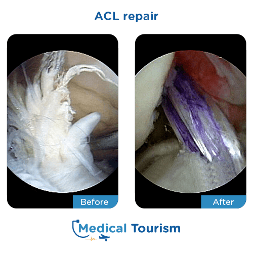 ACL repair before after
