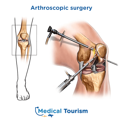 Arthroscopy Before After