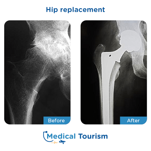 Hip replacement before after