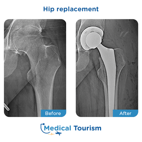 Hip replacement before after